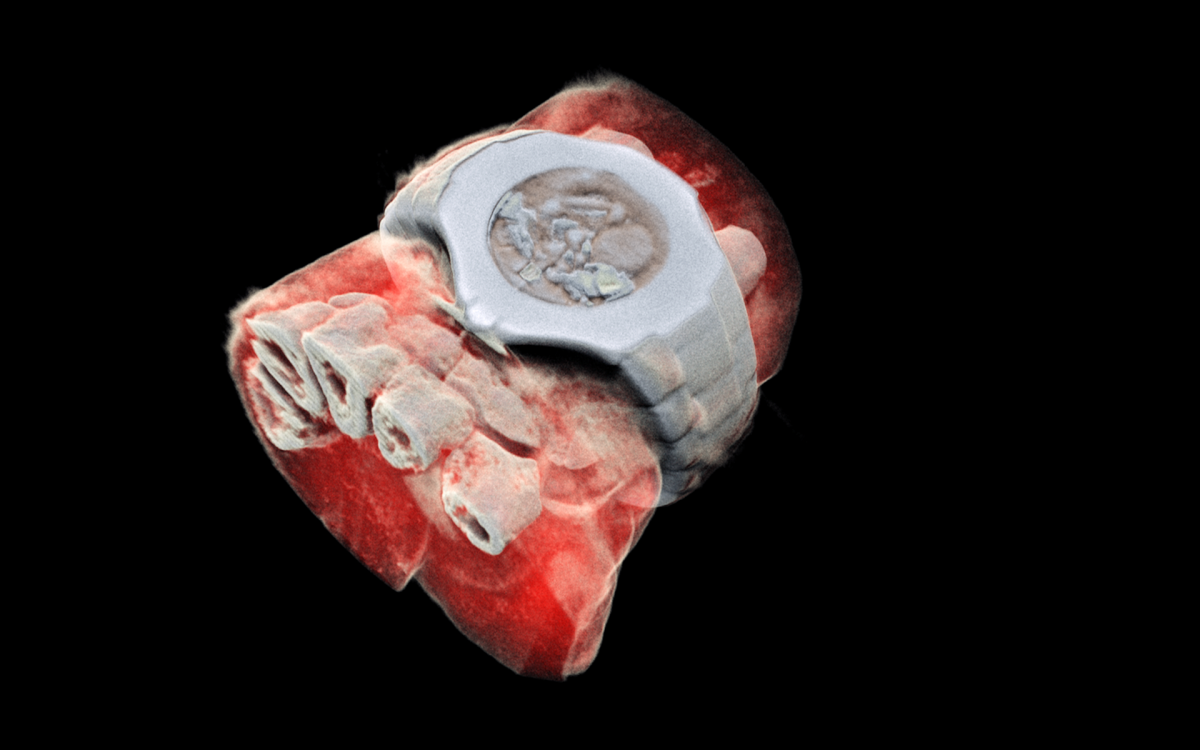 A 3D image of a wrist with a watch, showing part of the finger bones in white and soft tissue in red