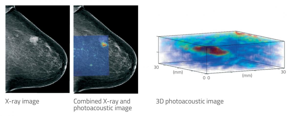 Figure 2: Comparison between X-ray and photoacoustic tomography for breast tumour imaging. 