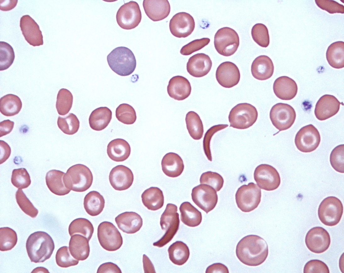 Red blood cells, some showing sickled shape