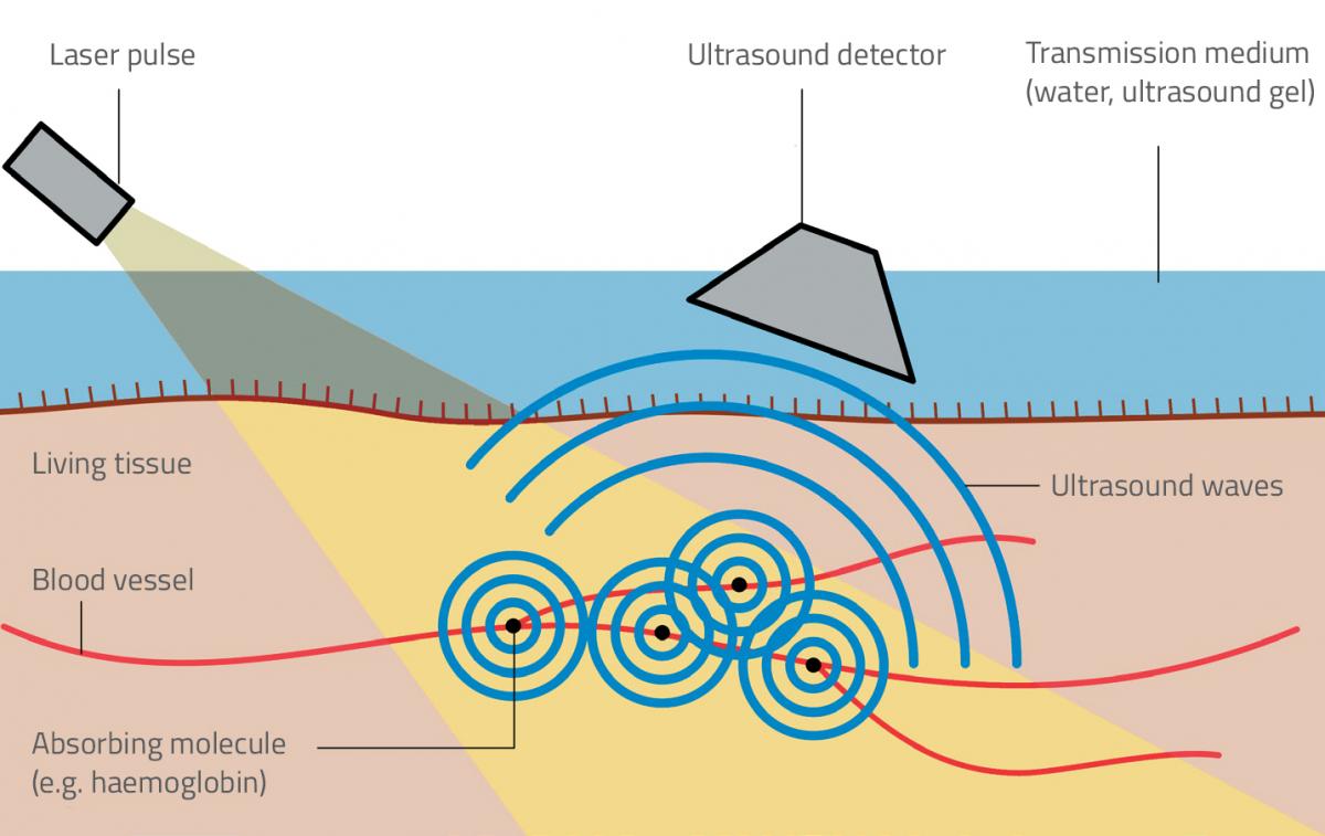 Figure 1: How photoacoustic imaging works. 